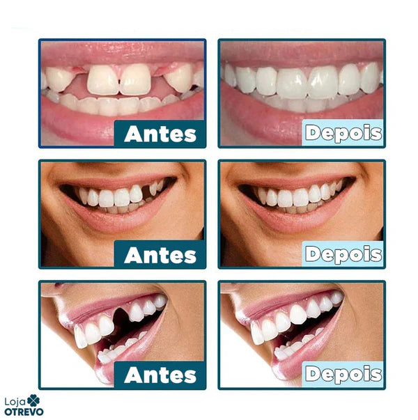 (Compre 1 Leve 2) Faceta Dental White Ajustável - Inferior e Superior | BRINDE CAPINHA PROTETORA e ESCOVA DE DENTE ELÉTRICA +FRETE GRÁTIS!